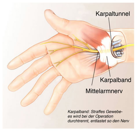 Bei einem Karpaltunnelsyndrom ist der Mittelnerv im Handgelenk beschädigt