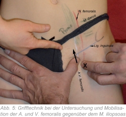 Abb. 5: Grifftechnik bei der Untersuchung und Mobilisation der A. und V. femoralis gegenüber dem M. iliopsoas